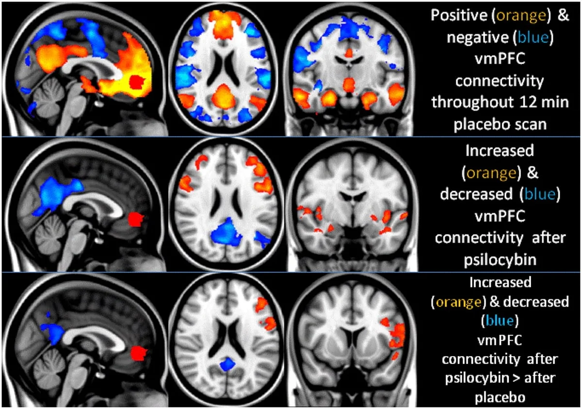 Beyin ve benlik: Psilocybin ile MRI içinde meditasyonun yeni bulguları